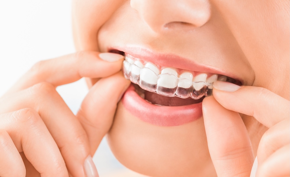 $3910 All Inclusive Invisalign